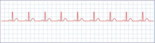 Sudden Cardiac Arrest Normal Heart Rhythm